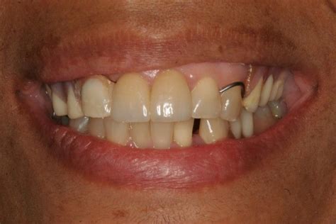 partial dentures without metal clasps